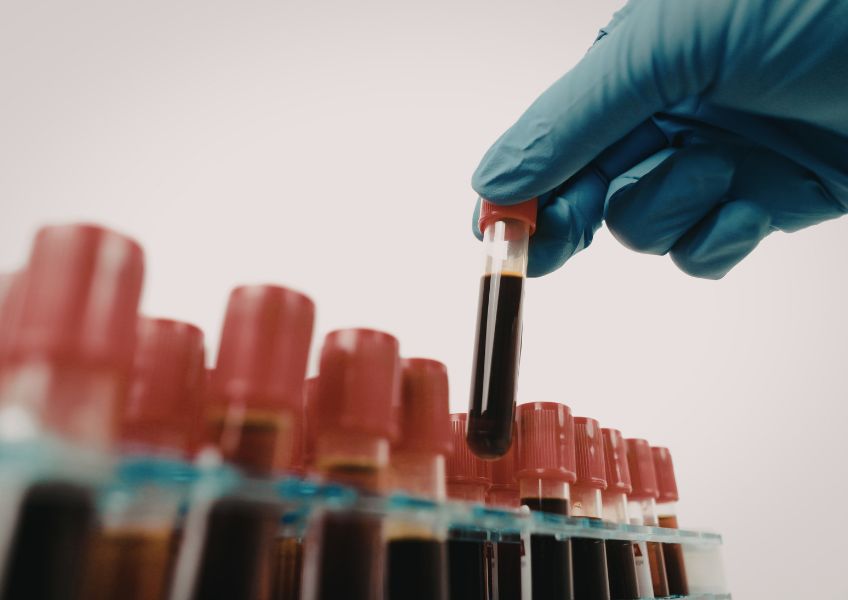 Mão com luva de borracha peando tudo de exame de sangue para analisar os marcadores laboratoriais.